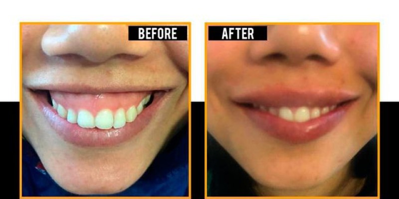 20% Discount at Defence Skin Clinic With Alied Bank 4 