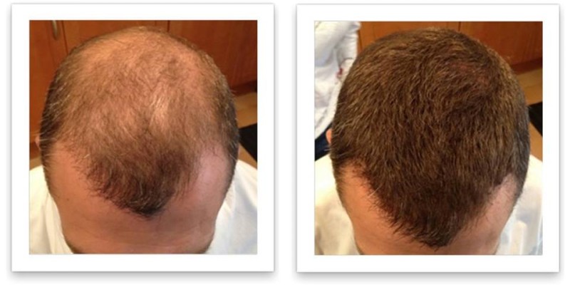 Caboki Hair Fiber Hair concealer in Karachi image 10